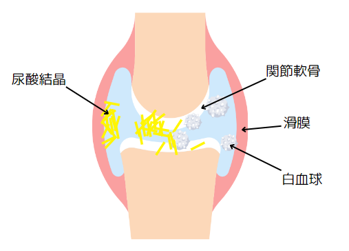 高尿酸血症とは